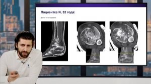 Перелом пилона.Pilon fracture. (by TRAUMA.CLUB | Профессиональный клуб травматологов-ортопедов)