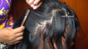 Dandruff Removal, Itchy Scratching, Huge Flakes And Relaxing With Music (Christmas Song) #406