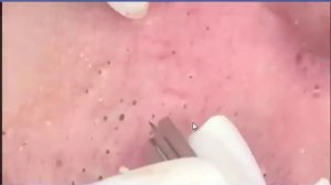 how to removal blackhead and how to get rid of blackhead blackhead on face