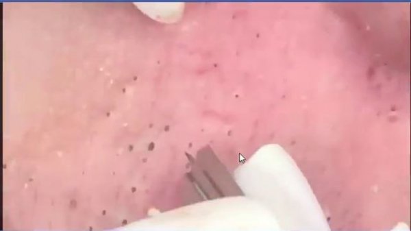 how to removal blackhead and how to get rid of blackhead blackhead on face