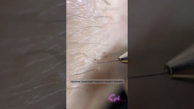 Процесс электроэпиляции. #эпиляция #epil #электроэпиляция смотреть онлайн