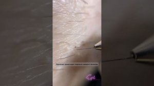 Процесс электроэпиляции. #эпиляция #epil #электроэпиляция