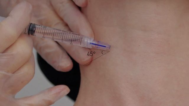 FILLMED Nanosoft Microneedles By Filorga