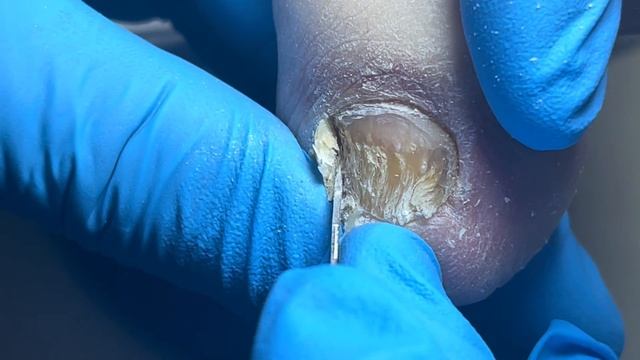 The little fingernail is infected with bacteria and the whole thing is broken【PedicureMaster LinJun