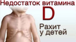 Что такое рахит? Рахит у детей, причины , симптомы, диагностика и лечение.