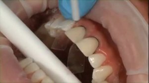 Композитные виниры