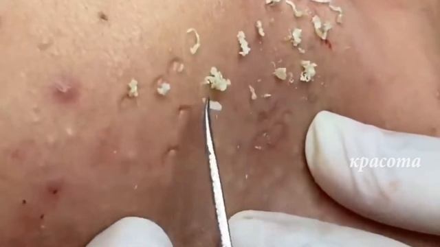 Как убрать черные точки НАВСЕГДА #01