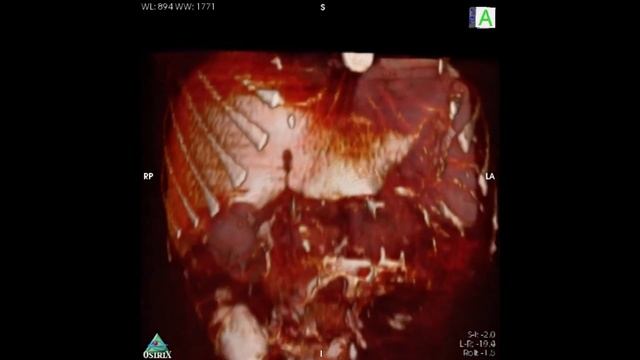 3D rendering of bowel DWI at 3.0 tesla смотреть онлайн