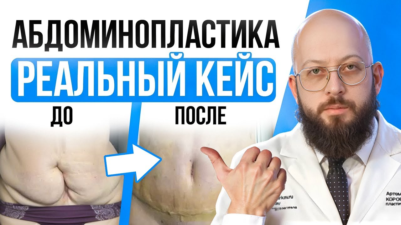 Эстетическое исправление деформации | Настоящий кейс по абдоминопластике смотреть онлайн