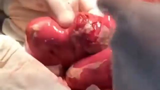 Перфорация кишечника смотреть онлайн