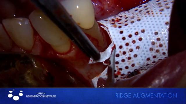 Иштван Урбан. Аугментация гребня по вертикали с применением мембраны RPM