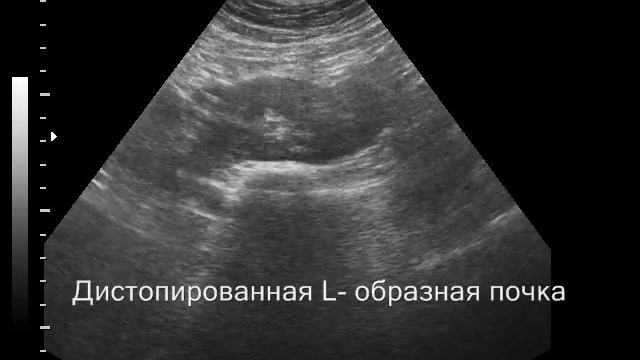 Подвздошная дистопия L образной почки смотреть онлайн