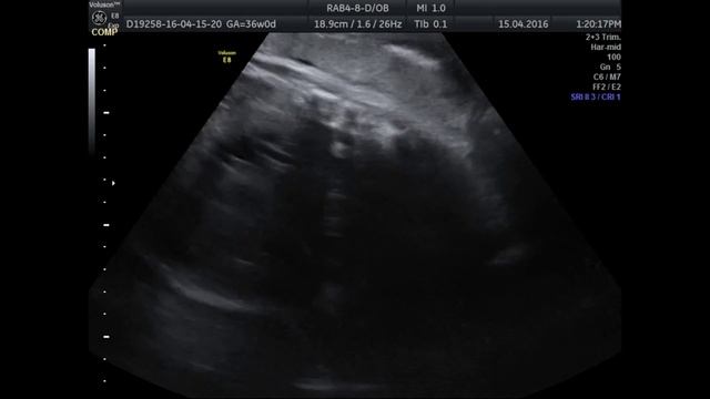 Киста яичника смотреть онлайн