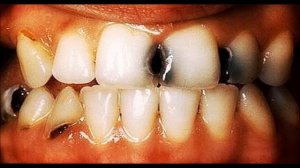 ЧТО БУДЕТ ЕСЛИ НЕ ЧИСТИТЬ ЗУБЫ