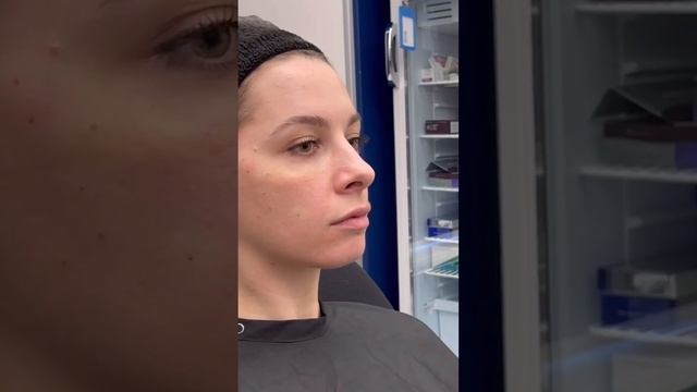 Показания для коррекции углов челюсти #советыкосметолога #shorts смотреть онлайн