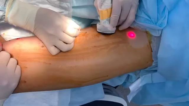 Методика лазерного лечения варикоза - ЭВЛК