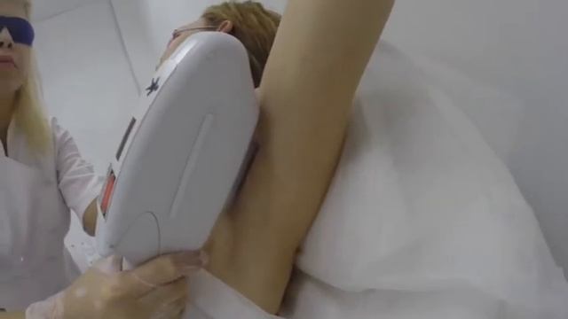 Эпиляция IPLASER смотреть онлайн