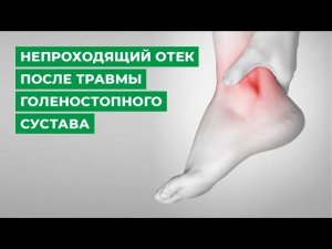 Непроходящий отек после травмы голеностопного сустава
