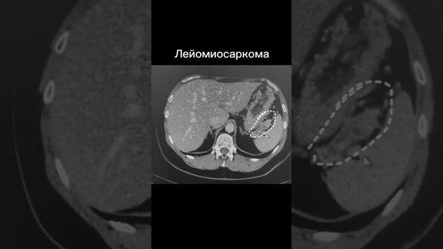 Лейомиосаркома смотреть онлайн