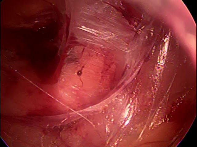 Laparoscopic ETEP Retorectus Diastasis Repair Non Edited Video