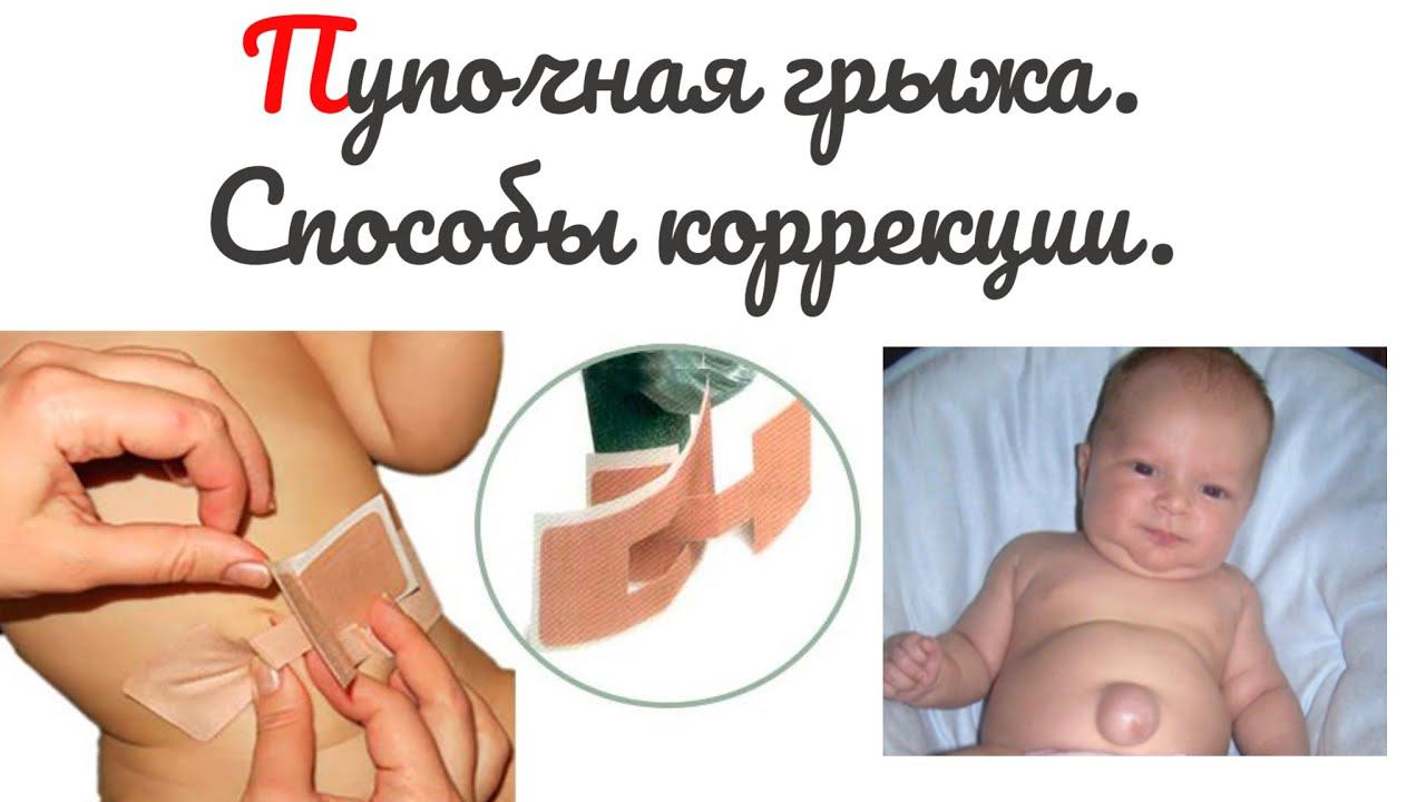 Пупочная грыжа у новорождённых.Лечение грыжи без операции.Специальный пупочный пластырь.