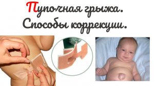 Пупочная грыжа у новорождённых.Лечение грыжи без операции.Специальный пупочный пластырь.