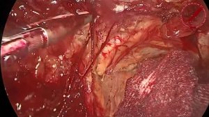 eTEP  (Эндоскопическая тотальная экстраперитонеальная пластика) левосторонней паховой грыжи