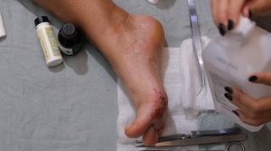 Что будет если наступить на морского ежа?