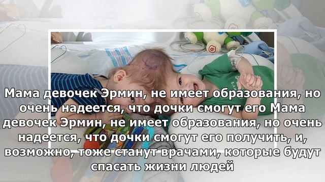 Впервые, после того, как их разделили, сиамские близнецы увидели друг друга смотреть онлайн
