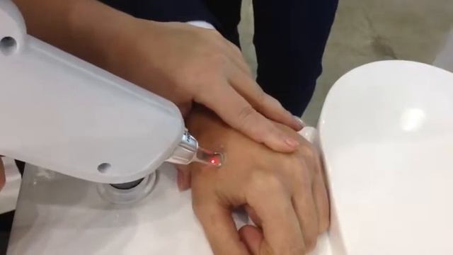 Удаление татуировки неодимовым лазером CAPELLO смотреть онлайн