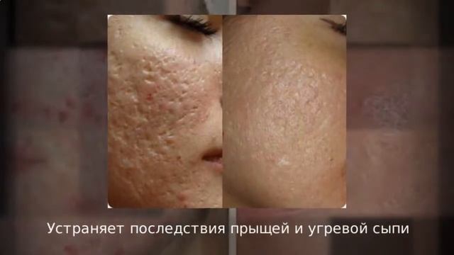 Карандаш Enlever от прыщей и рубцов смотреть онлайн