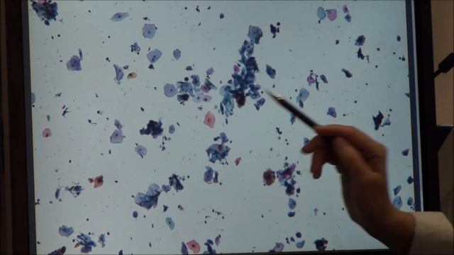 Атрофия в традиционном и жидкостном мазках смотреть онлайн