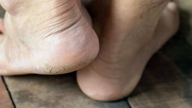 Почему появляются трещины на пятках смотреть онлайн