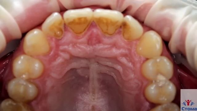 removal of tartar , plaque removal , oral hygiene , brushing teeth , irrigator смотреть онлайн