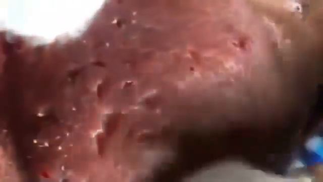 НОВОЕ ВИДЕО 2021  Прыщи давить залипательные