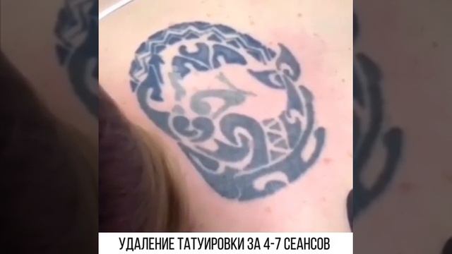 Удаление татуировки в салоне красоты SIX RULES в городе Владимир