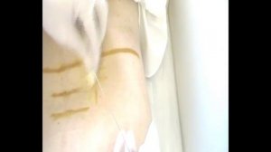 Блокада паравертебральная корешковая L5