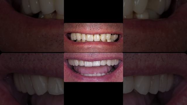 Имплантация зубов.Виниры.Тотальное протезирование.@dr_karlov смотреть онлайн