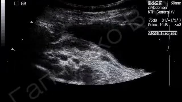 УЗИ желудка (рак с изъязвлением тела по большой кривизне) смотреть онлайн