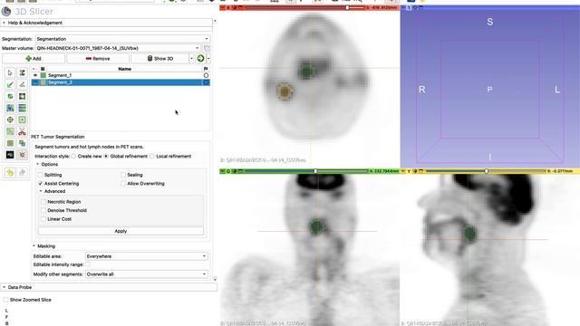PET Tumor Segmentation Extension (2022) смотреть онлайн