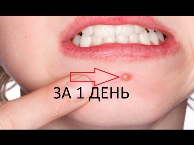 7 ПРОСТЫХ СПОСОБОВ избавится от ПРЫЩЕЙ за 1 ДЕНЬ смотреть онлайн