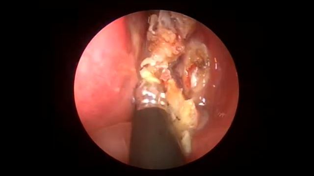 Полипы нос Polyposis Sinusitis