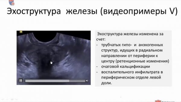 Узи простаты.mp4