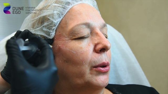 Контурная пластика в деталях. Клиника в Новосибирске Dune Ego. смотреть онлайн