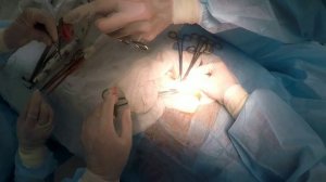 Аппендэктомия