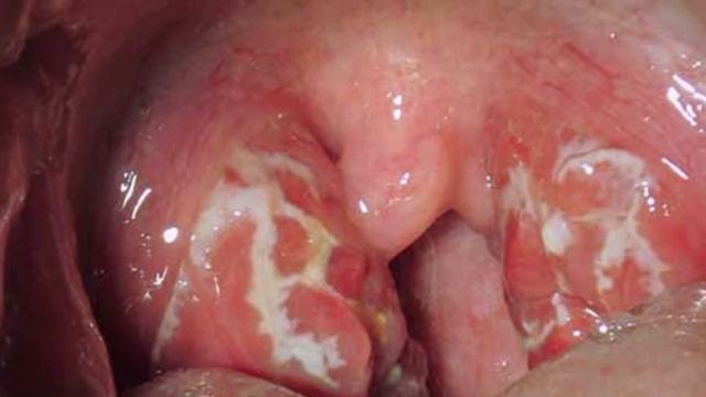 ПОЧЕМУ ВОЗНИКАЕТ НЕПРИЯТНЫЙ ЗАПАХ ИЗО РТА?