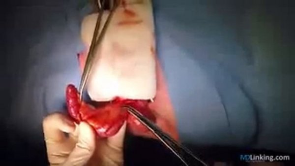 Аппендэктомия. С