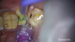 Одномоментная имплантация , удаление зуба и сразу установка импланта , скололся зуб , треснул зуб