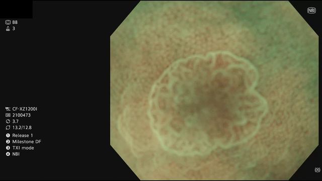 Colonoscopy (tubular adenoma LGD) with AI+TXI+NBI+zoom x135 смотреть онлайн