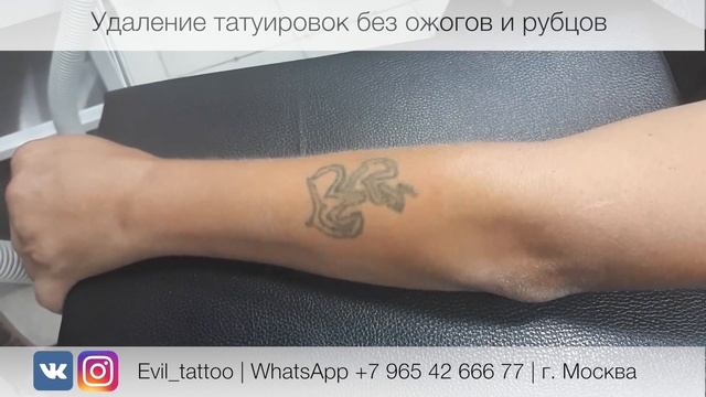 Лазерное удаление татуировки в студии Evil Tattoo. Без травм, ожогов и рубцов. смотреть онлайн